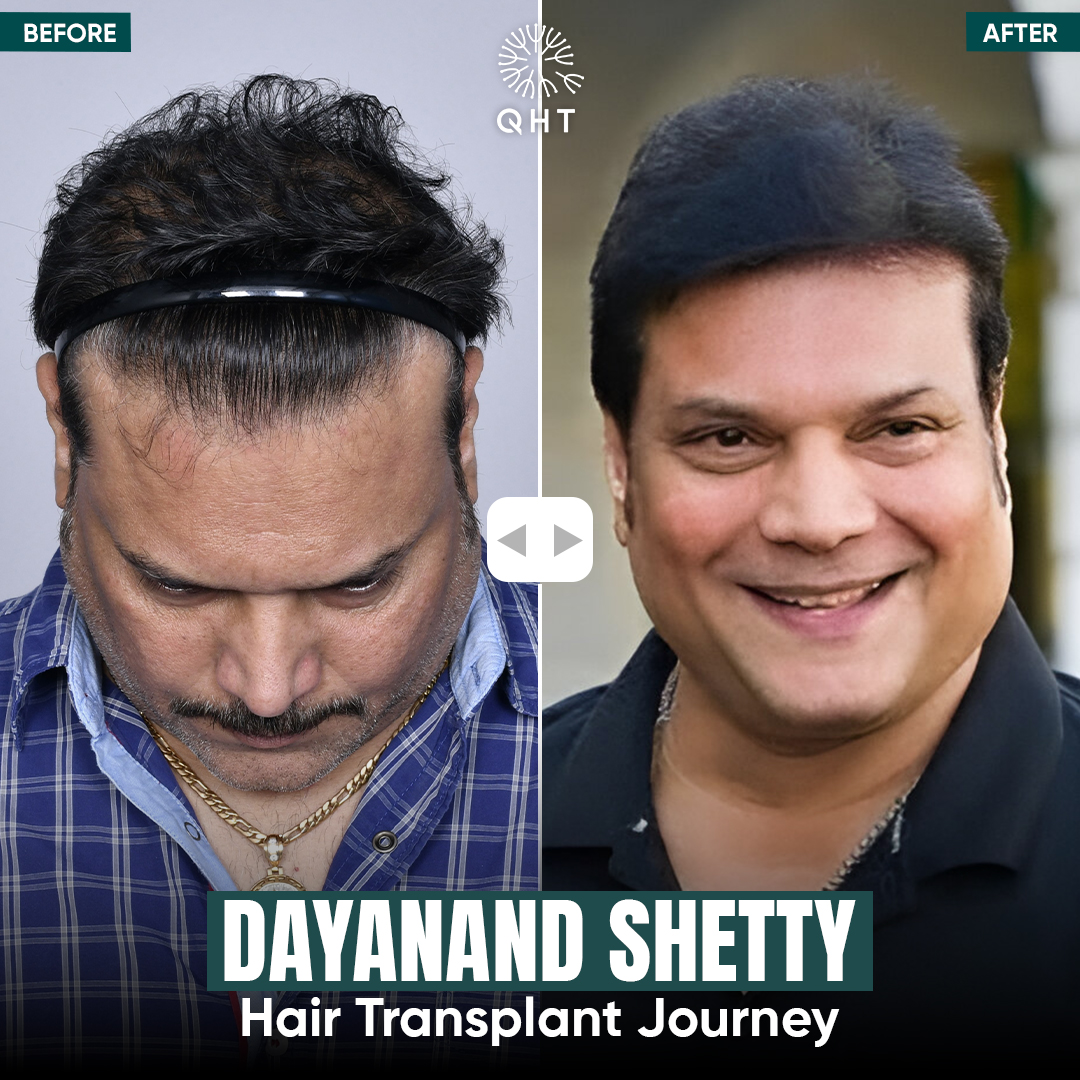 Hair Transplant Cost in India: Your Complete 2025 Guide
